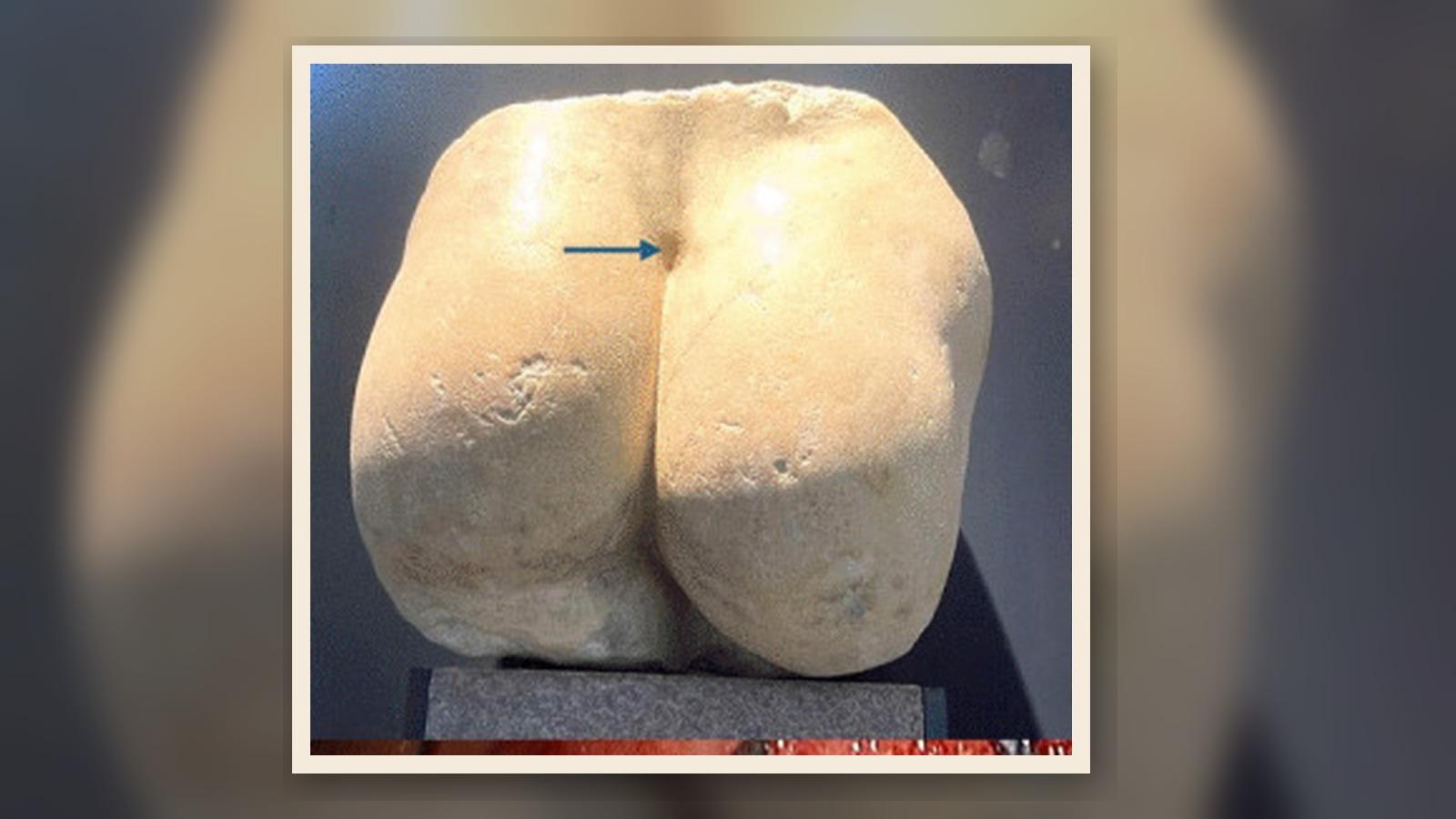 Ancient Roman Sculptures as Early Depictions of Occult Spinal Dysraphism