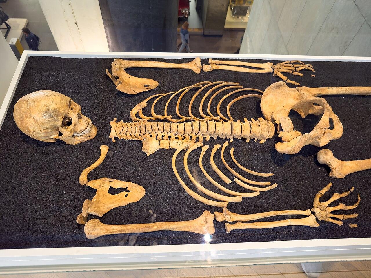 Ancient DNA Reveals HLA Genes Linked to Leprosy Risk in Medieval Europe